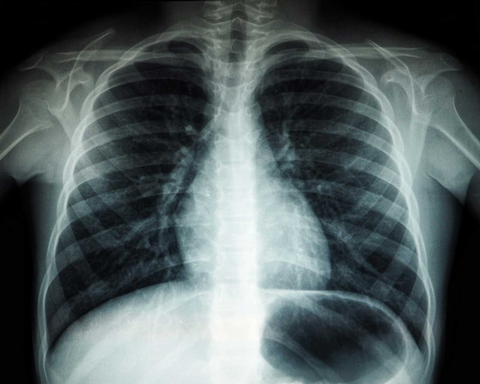 Getting a radiographic scan (MRI, CT scan, X-ray etc.) and report back from a radiologist can be a confusing and confronting time, so lets learn how to understanding your scans. Thankfully the team at Peak Osteopathy is trained to guide you through this process and will discuss the contents of your report with you in detail to dissect what bits relate to your pain and what to do next.